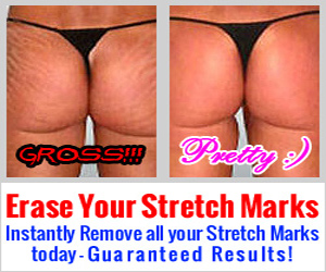 Erase Your Stretch Marks